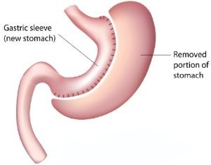 Gastric sleeve image