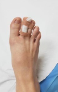 Broken toe.jpg