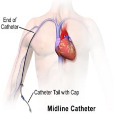 Midline image showing end of catheter in body (on left) and catheter tail with cap outside the arm.