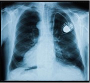 Pacemaker in chest