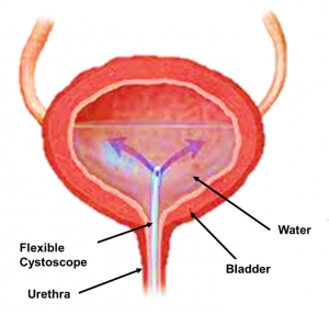 Illustration of bladder showing the telescope and urethra