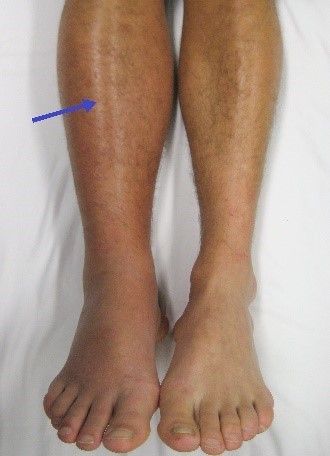 Photo of lower legs, one with swelling and darker colour due to DVT