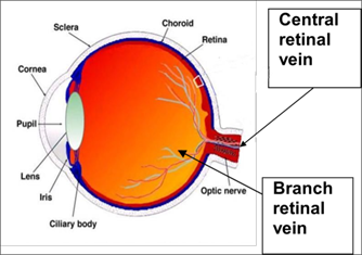 Retinal vein occlusion image