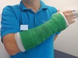 Arm in cast