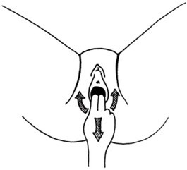 Illustration of perineal massage