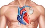 Pacemaker in chest