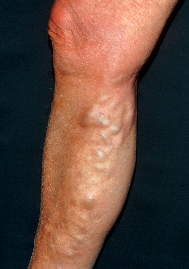 varicose veins.png