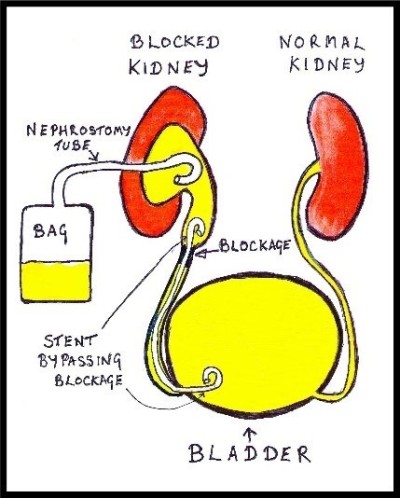 Nephrostomy image