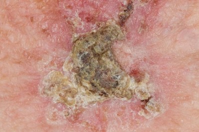 Actinic keratosis picture.jpg