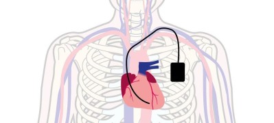 NHS image of pacemaker