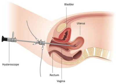 Hysteroscopy image