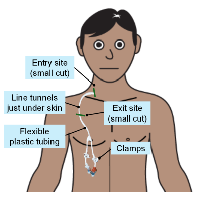 Hickman line