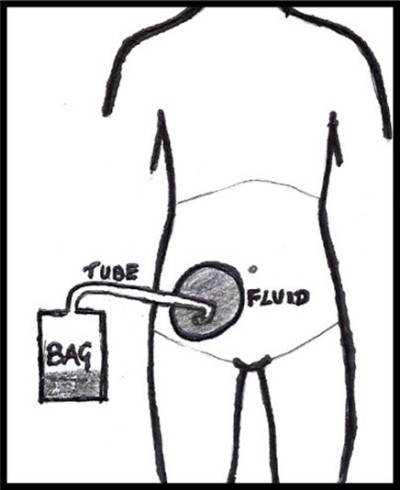 Percutaneous fluid drainage image