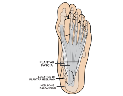 plantar-fasciitis-1.png