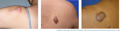 Keloid photos