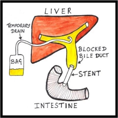 Biliary image