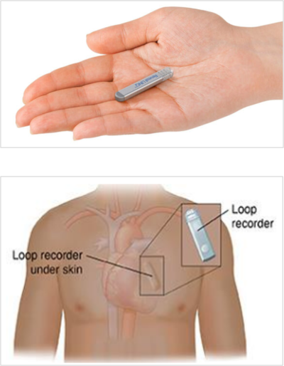 ILR images; bottom shows loop recorder inside chest