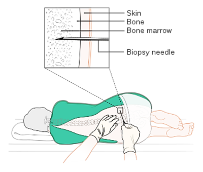 Illustration of patient lying on side with needle being inserted into spine