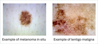 Example of melanoma-in-situ (left) and lentigo meligna (right)