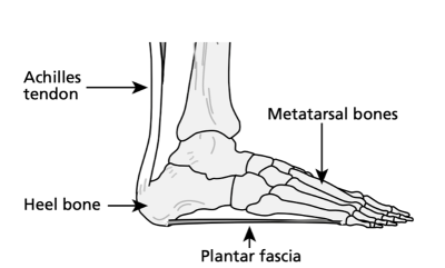 Plantar-fasciitis-2.png