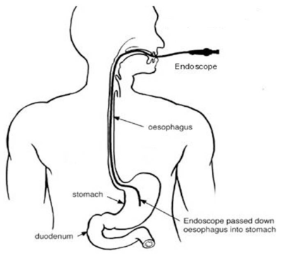 Gastroscopy.png