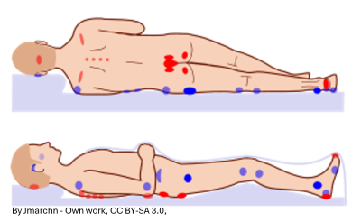 Pressure sores picture with copyright license.png