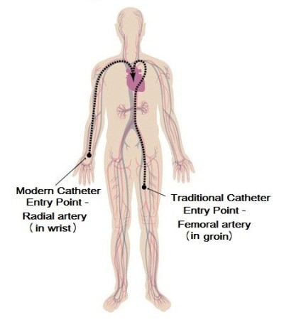 Catheter entry point image