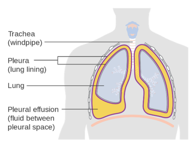 Diagram of the lungs showing pleural effusion