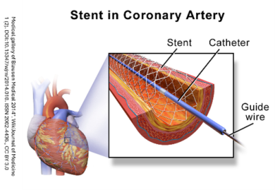 Angioplasty